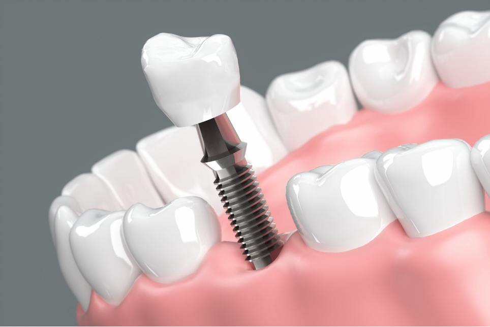 安いインプラントは本当に大丈夫？価格と安全性の関係を徹底解説