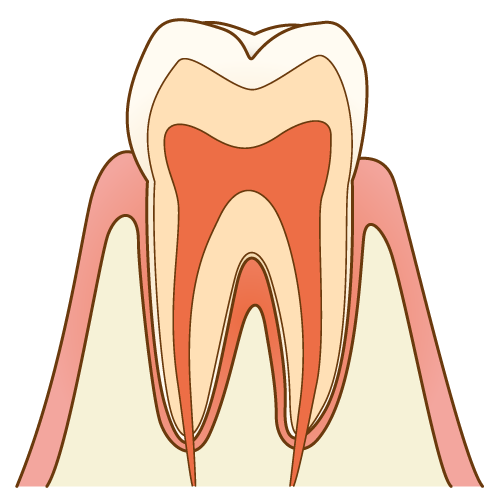 虫歯ができてしまう原因は何なのか？