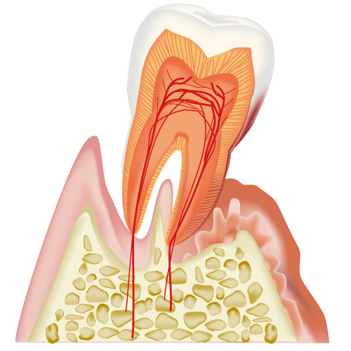 歯周病に侵された歯の断面