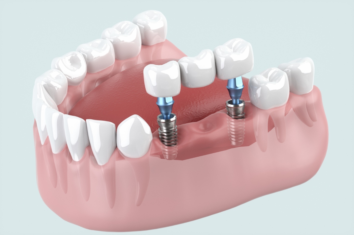 インプラントと差し歯の違いを徹底解説！費用・見た目・寿命まで比較